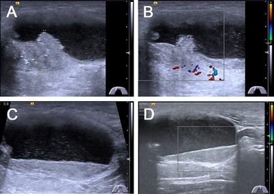 Value of Contrast-Enhanced Ultrasound in Partially Cystic Papillary Thyroid Carcinomas